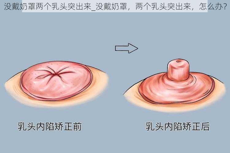 没戴奶罩两个乳头突出来_没戴奶罩，两个乳头突出来，怎么办？